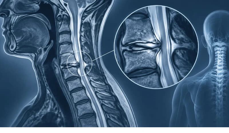 Illustration médicale du rachis cervical accompagnant un article de blog